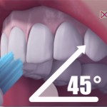 Čo spôsobuje zubný kameň a ako sa mu vyvarovať ?